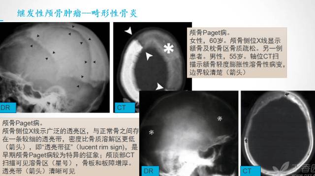 【PPT】颅骨肿瘤及肿瘤性病变影像学详解