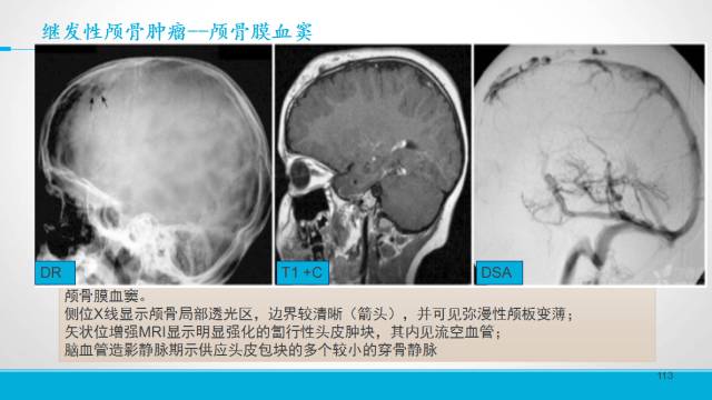【PPT】颅骨肿瘤及肿瘤性病变影像学详解