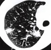 “星系征” 的影像表现与临床意义 “星系征” 的影像表现与临床意义