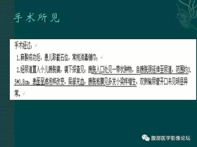 【病例】膀胱胚胎性横纹肌肉瘤1例CT影像表现