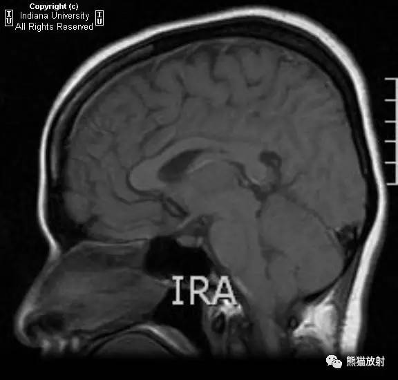 【病例】脑囊虫病1例MR影像表现
