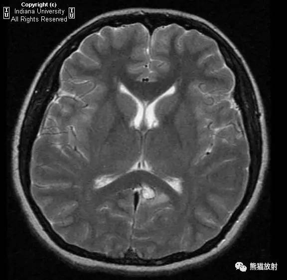【病例】脑囊虫病1例MR影像表现 【病例】脑囊虫病1例MR影像表现