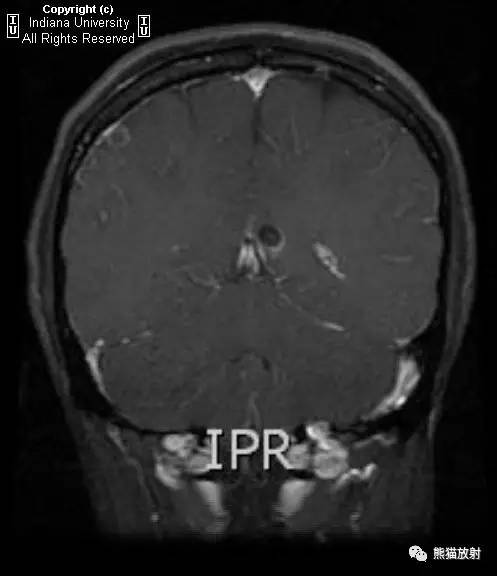 【病例】脑囊虫病1例MR影像表现 【病例】脑囊虫病1例MR影像表现