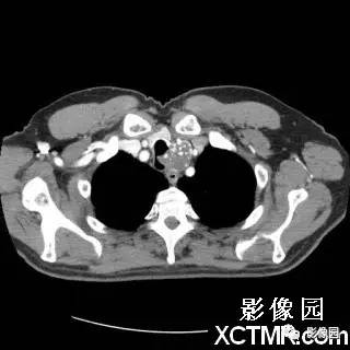 【病例】原发性气管软管肉瘤1例CT影像表现