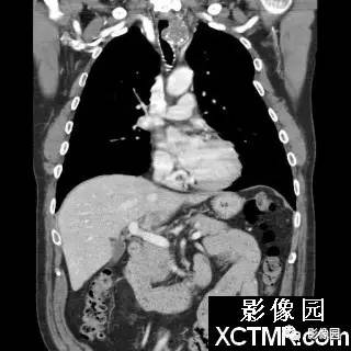 【病例】原发性气管软管肉瘤1例CT影像表现