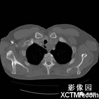 【病例】原发性气管软管肉瘤1例CT影像表现