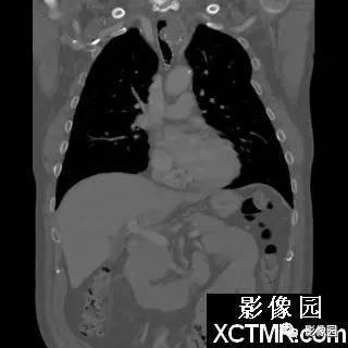 【病例】原发性气管软管肉瘤1例CT影像表现
