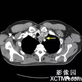 【病例】原发性气管软管肉瘤1例CT影像表现