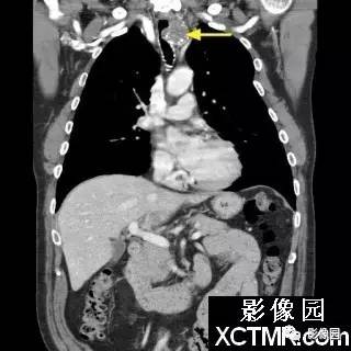 【病例】原发性气管软管肉瘤1例CT影像表现