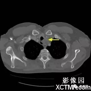 【病例】原发性气管软管肉瘤1例CT影像表现