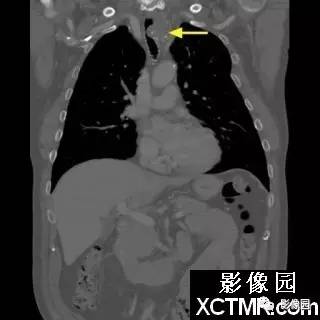 【病例】原发性气管软管肉瘤1例CT影像表现