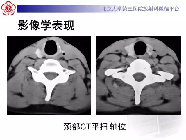 【病例】鳃裂囊肿伴感染1例CT影像表现