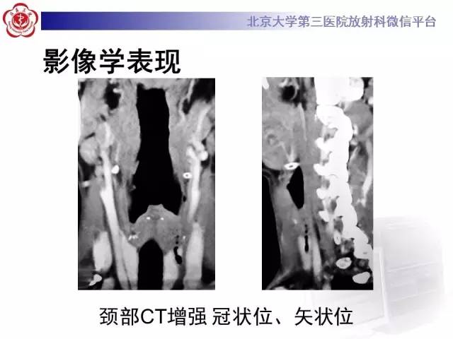 【病例】鳃裂囊肿伴感染1例CT影像表现