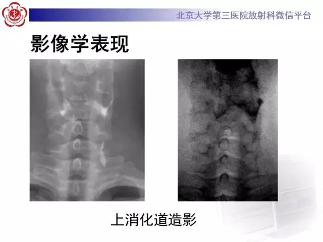 【病例】鳃裂囊肿伴感染1例CT影像表现