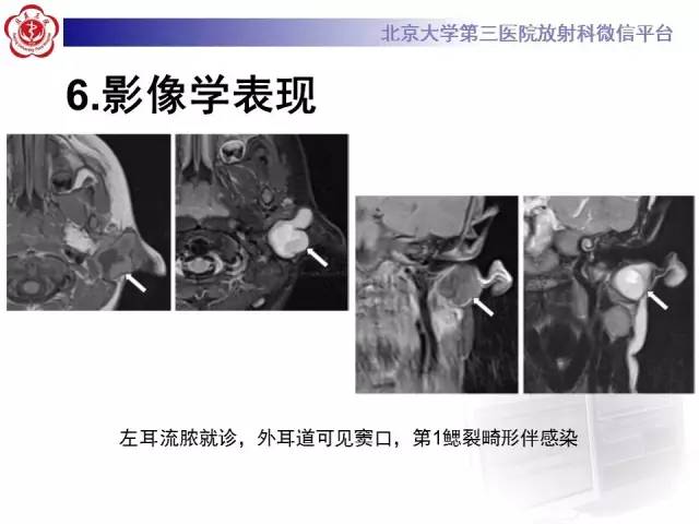 【病例】鳃裂囊肿伴感染1例CT影像表现