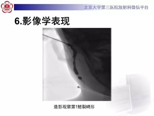 【病例】鳃裂囊肿伴感染1例CT影像表现
