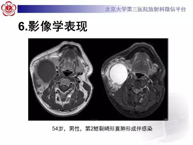 【病例】鳃裂囊肿伴感染1例CT影像表现