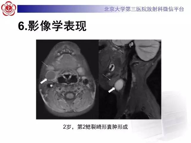 【病例】鳃裂囊肿伴感染1例CT影像表现