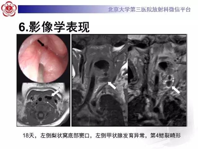【病例】鳃裂囊肿伴感染1例CT影像表现