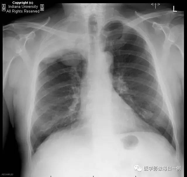 【病例】肺癌侵及胸壁、肋骨、脊椎、硬膜外1例CT及MR