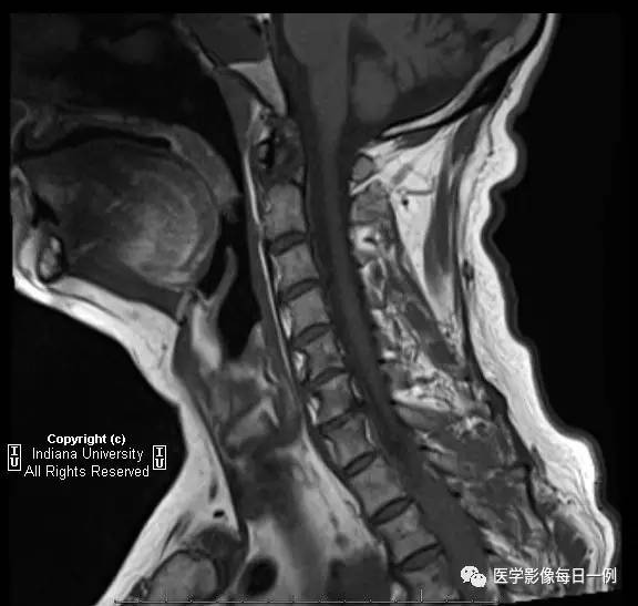 【病例】肺癌侵及胸壁、肋骨、脊椎、硬膜外1例CT及MR