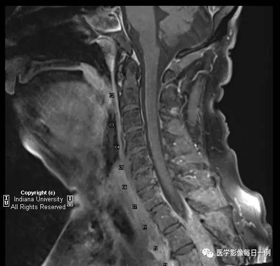 【病例】肺癌侵及胸壁、肋骨、脊椎、硬膜外1例CT及MR