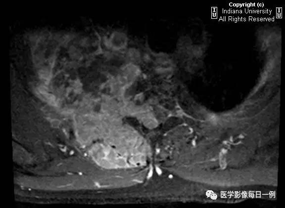 【病例】肺癌侵及胸壁、肋骨、脊椎、硬膜外1例CT及MR