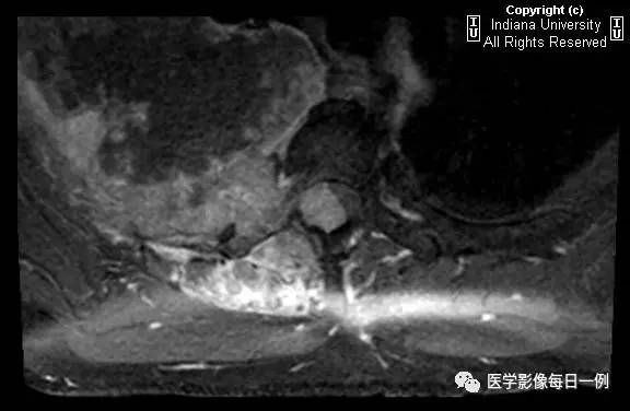 【病例】肺癌侵及胸壁、肋骨、脊椎、硬膜外1例CT及MR