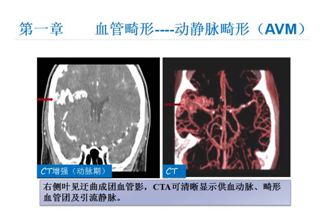 【PPT】颅脑血管性疾病影像学