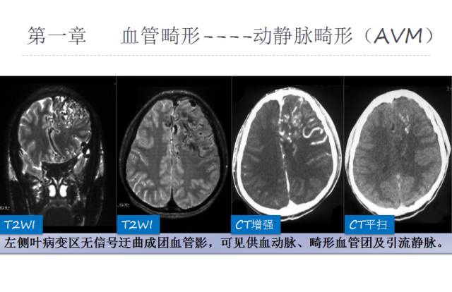 【PPT】颅脑血管性疾病影像学