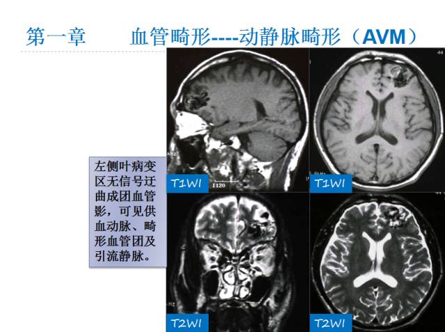 【PPT】颅脑血管性疾病影像学