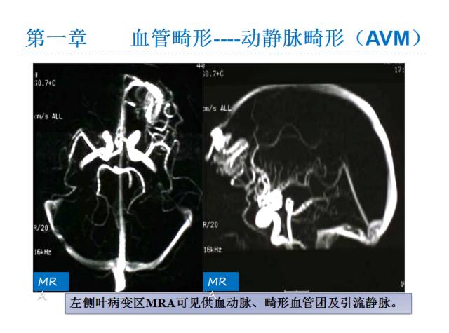 【PPT】颅脑血管性疾病影像学