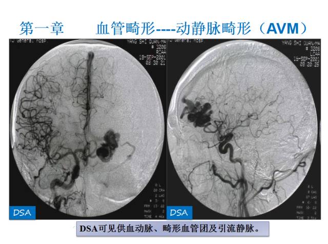【PPT】颅脑血管性疾病影像学