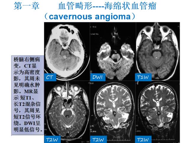 【PPT】颅脑血管性疾病影像学