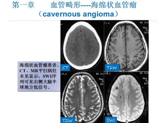 【PPT】颅脑血管性疾病影像学