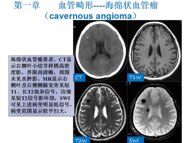 【PPT】颅脑血管性疾病影像学