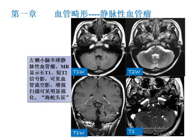 【PPT】颅脑血管性疾病影像学