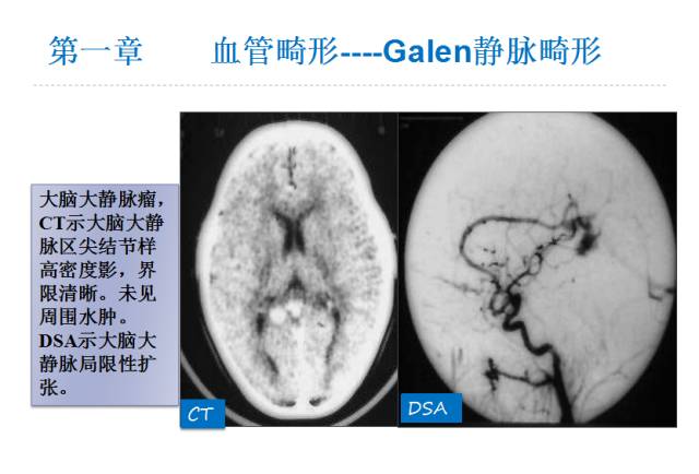 【PPT】颅脑血管性疾病影像学