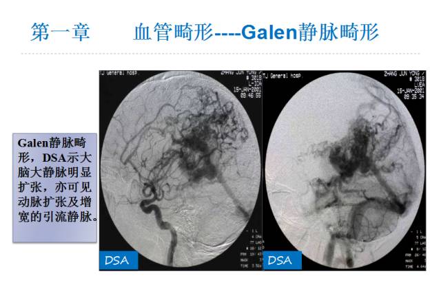 【PPT】颅脑血管性疾病影像学