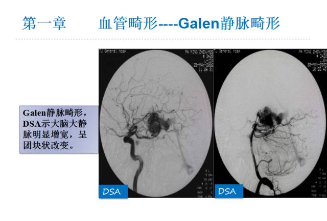 【PPT】颅脑血管性疾病影像学