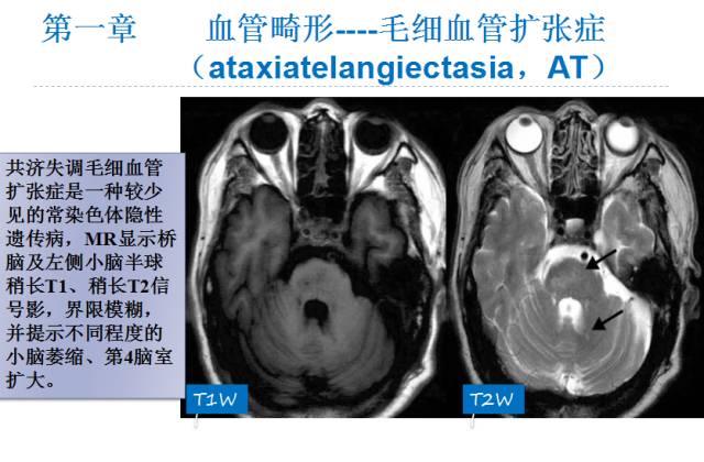 【PPT】颅脑血管性疾病影像学
