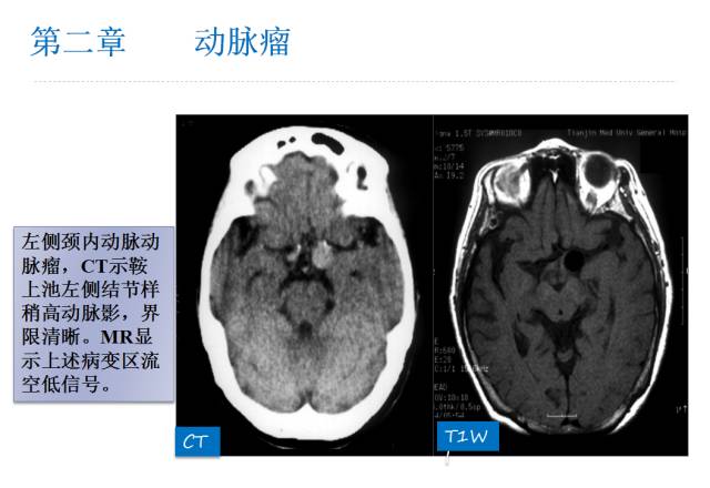 【PPT】颅脑血管性疾病影像学