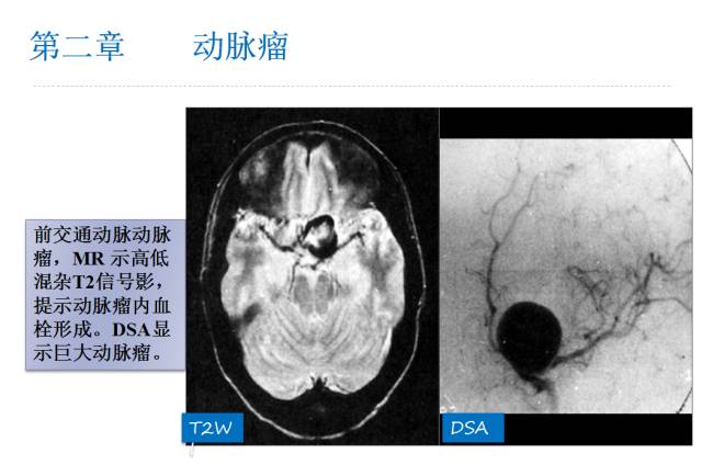 【PPT】颅脑血管性疾病影像学