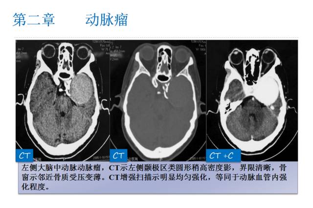 【PPT】颅脑血管性疾病影像学