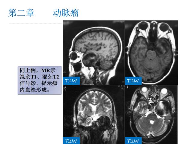 【PPT】颅脑血管性疾病影像学