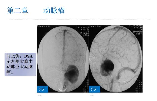 【PPT】颅脑血管性疾病影像学
