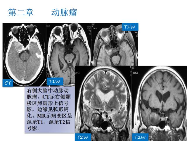 【PPT】颅脑血管性疾病影像学