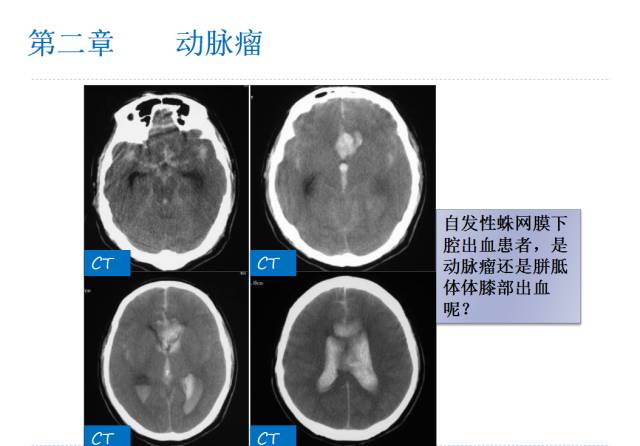 【PPT】颅脑血管性疾病影像学