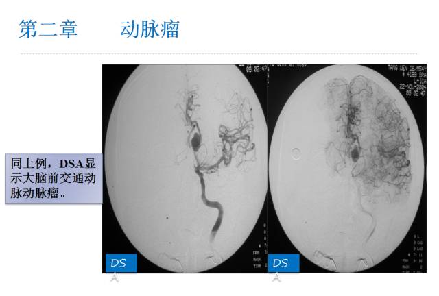 【PPT】颅脑血管性疾病影像学