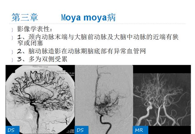 【PPT】颅脑血管性疾病影像学